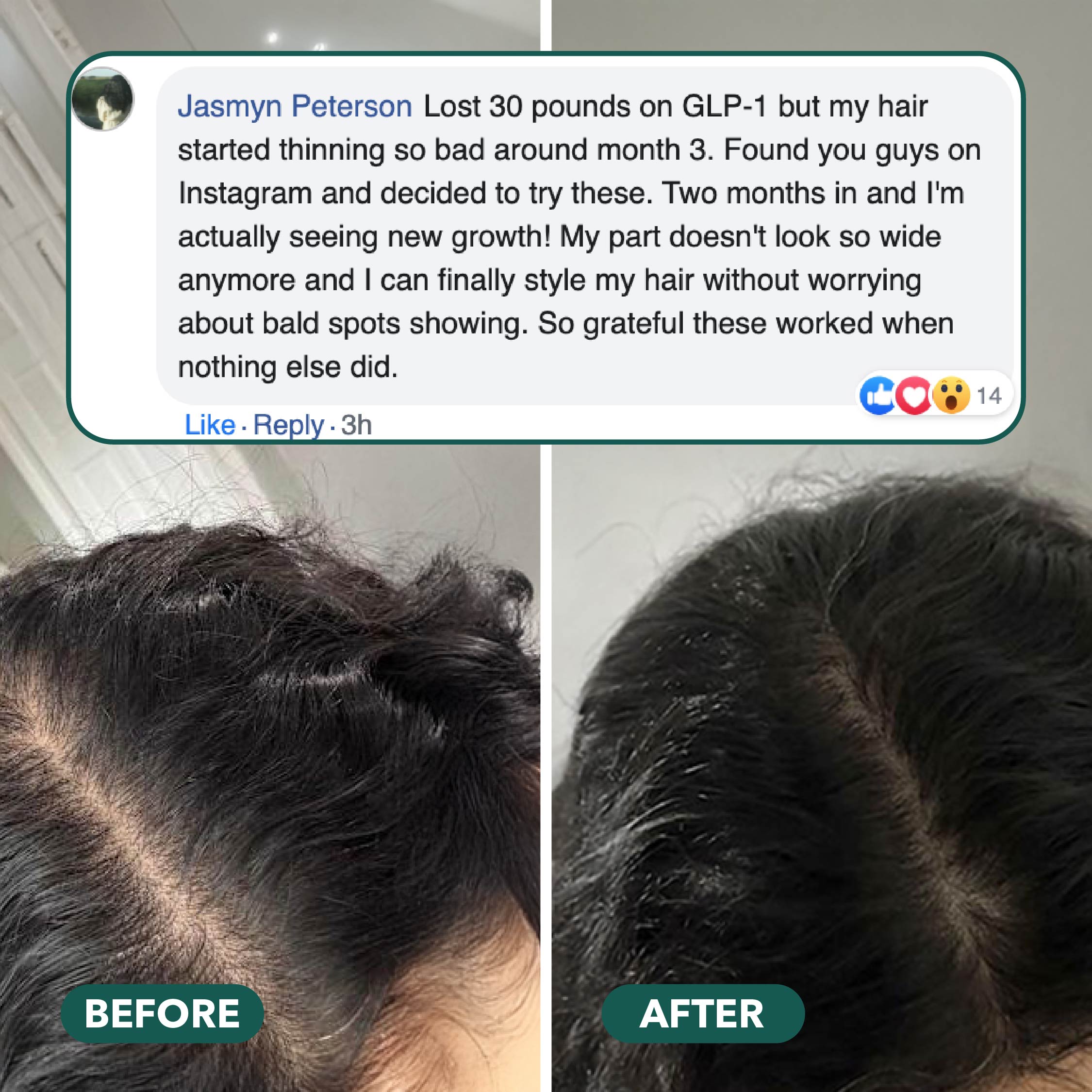 Balmbare Hair Growth Gummies Review: Do These Gummies Actually Support Hair Regrowth?