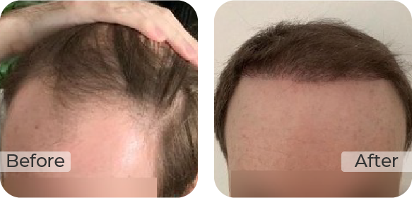 Twenty One Again Review 2026: Home Blood Tests & Hair Loss Treatments, Honestly